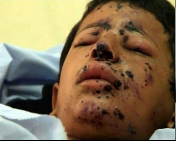 ۲۰۰۰ کودک از آغاز جنگ یمن کشته و زخمی شدهاند ۲۰۰۰ کودک از آغاز جنگ یمن کشته و زخمی شدهاند