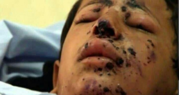 ۲۰۰۰ کودک از آغاز جنگ یمن کشته و زخمی شده‌اند